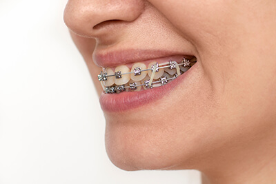 Closeup of Someone Smiling With Elastics on Their Braces