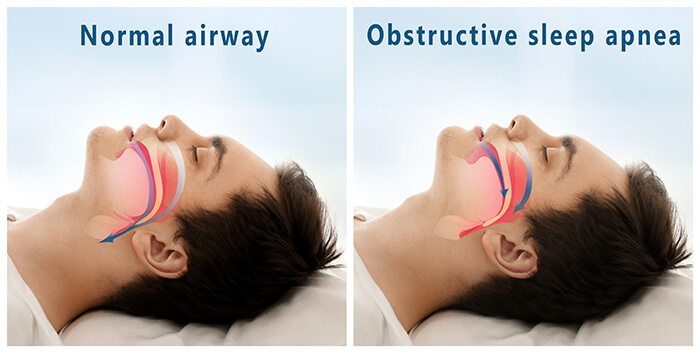 sleep apnea diagram